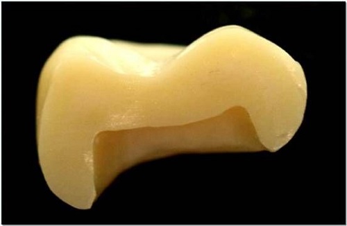 A profile of the zirconia denture soaked in dye solution